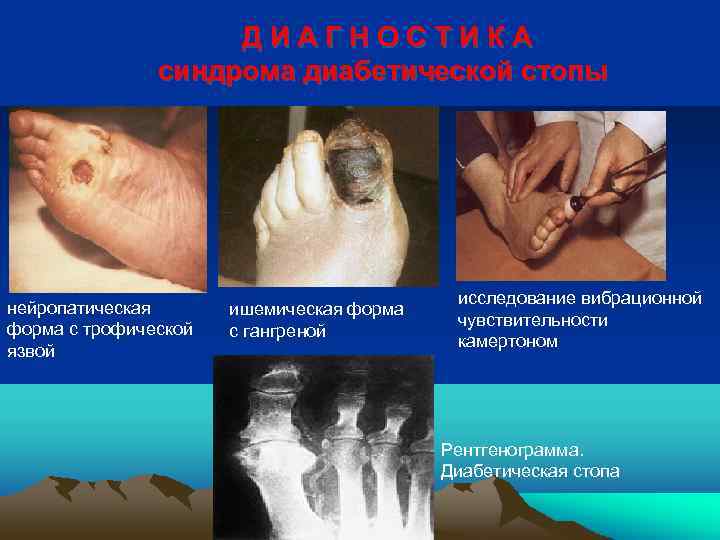 ДИАГНОСТИКА синдрома диабетической стопы нейропатическая форма с трофической язвой ишемическая форма с гангреной исследование