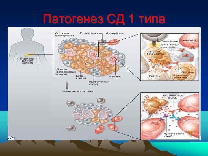 Патогенез СД 1 типа 