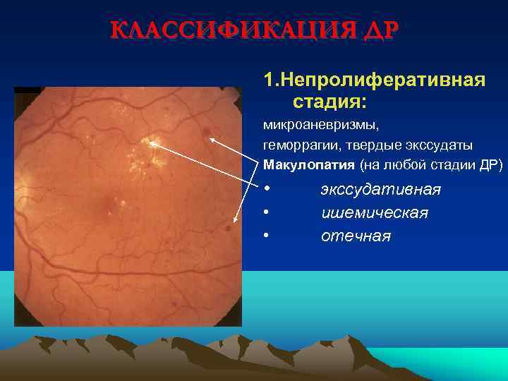 КЛАССИФИКАЦИЯ ДР 1. Непролиферативная стадия: микроаневризмы, геморрагии, твердые экссудаты Макулопатия (на любой стадии ДР)