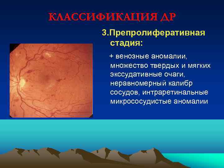 КЛАССИФИКАЦИЯ ДР 3. Препролиферативная стадия: + венозные аномалии, множество твердых и мягких экссудативные очаги,