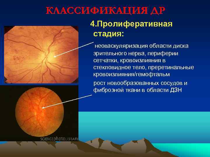КЛАССИФИКАЦИЯ ДР 4. Пролиферативная стадия: неоваскуляризация области диска зрительного нерва, периферии сетчатки, кровоизлияния в