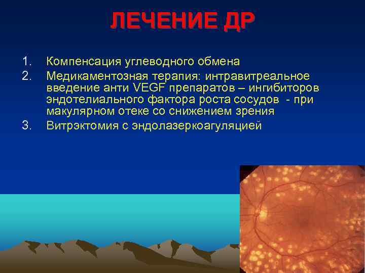 ЛЕЧЕНИЕ ДР 1. 2. 3. Компенсация углеводного обмена Медикаментозная терапия: интравитреальное введение анти VЕGF