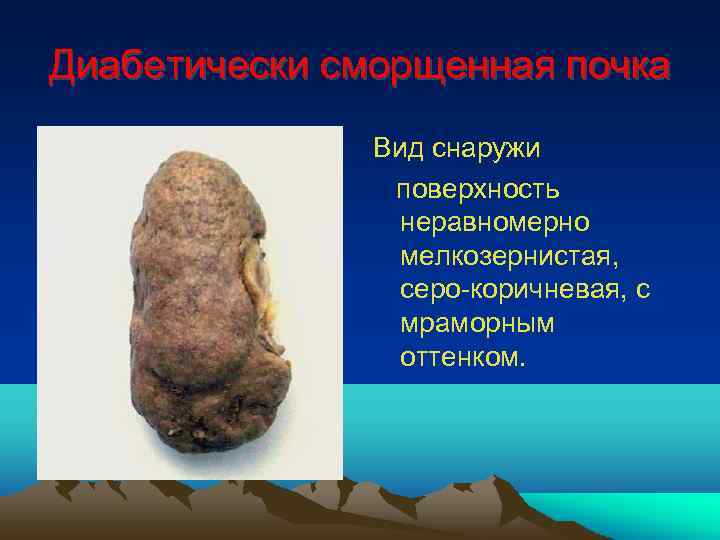 Диабетически сморщенная почка Вид снаружи поверхность неравномерно мелкозернистая, серо-коричневая, с мраморным оттенком. 