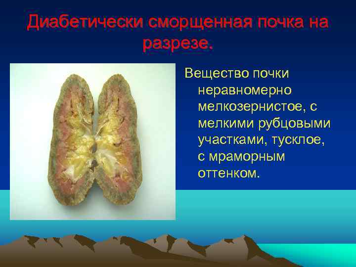 Диабетически сморщенная почка на разрезе. Вещество почки неравномерно мелкозернистое, с мелкими рубцовыми участками, тусклое,