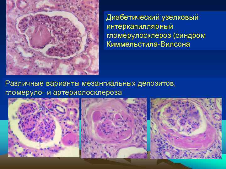 Диабетический узелковый интеркапиллярный гломерулосклероз (синдром Киммельстила-Вилсона). Различные варианты мезангиальных депозитов, гломеруло- и артериолосклероза 