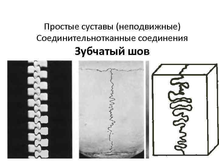 Простые суставы (неподвижные) Соединительнотканные соединения Зубчатый шов 