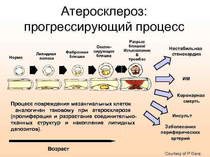 Атеросклероз: прогрессирующий процесс Норма Липидная полоса Фиброзная бляшка Окклюзирующая бляшка Разрыв бляшки/ Изъязвление &