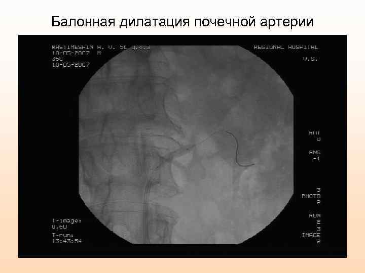 Балонная дилатация почечной артерии 