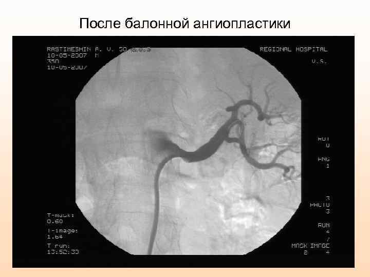 После балонной ангиопластики 