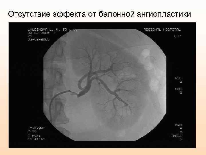 Отсутствие эффекта от балонной ангиопластики 