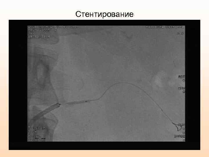 Стентирование 
