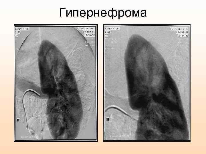 Гипернефрома 