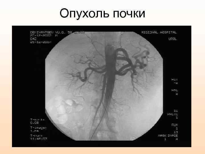 Опухоль почки 