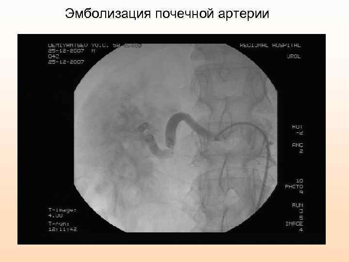 Эмболизация почечной артерии 