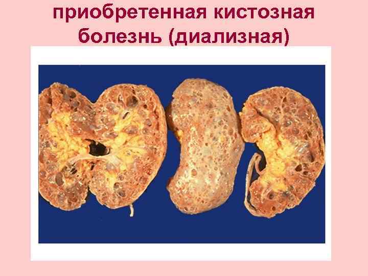 приобретенная кистозная болезнь (диализная) 
