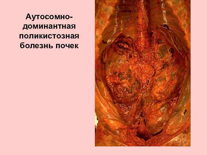 Аутосомнодоминантная поликистозная болезнь почек 