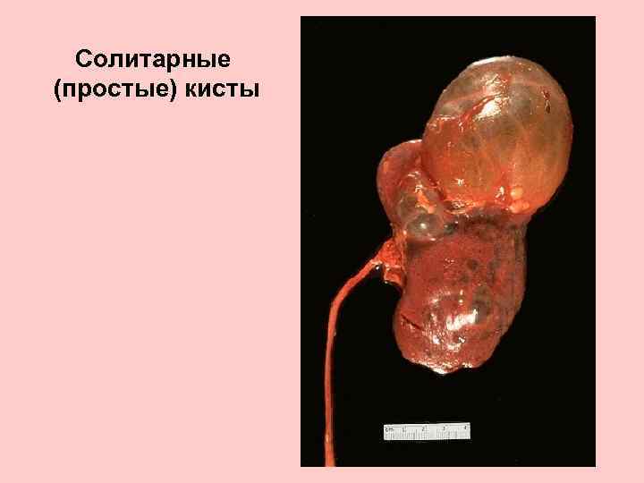 Солитарные (простые) кисты 