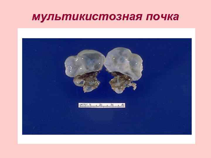 мультикистозная почка 