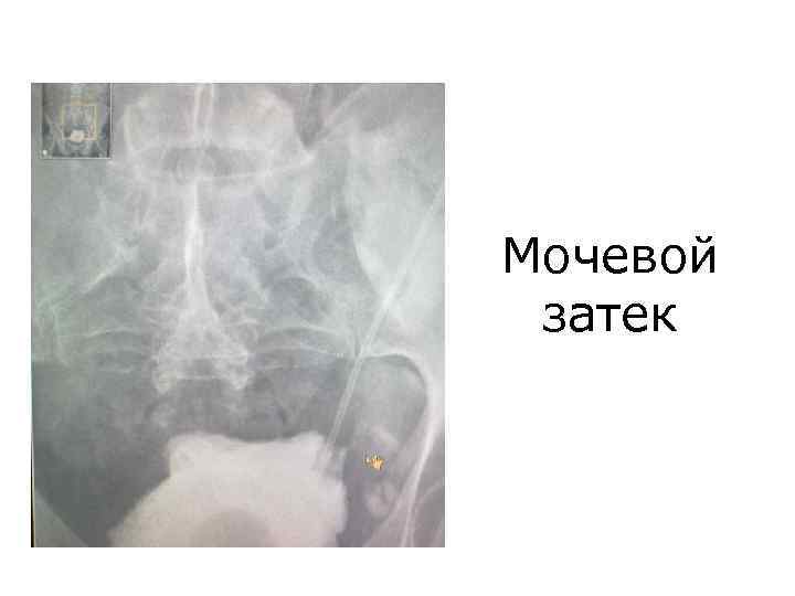 Мочевой затек 