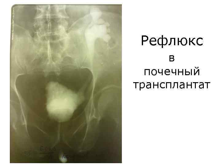Рефлюкс в почечный трансплантат 