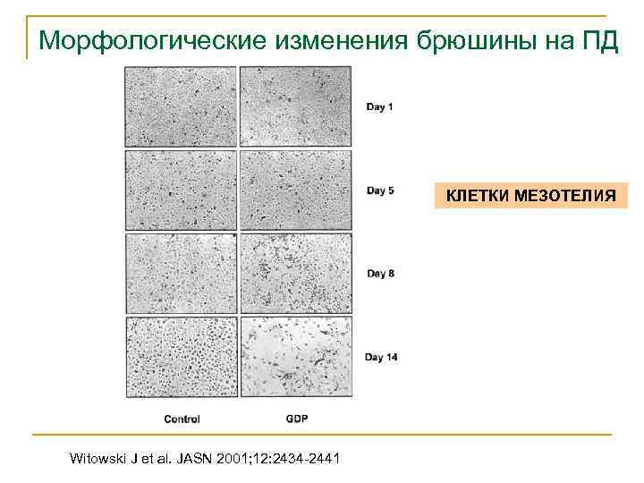 Морфологические изменения брюшины на ПД КЛЕТКИ МЕЗОТЕЛИЯ Witowski J et al. JASN 2001; 12: