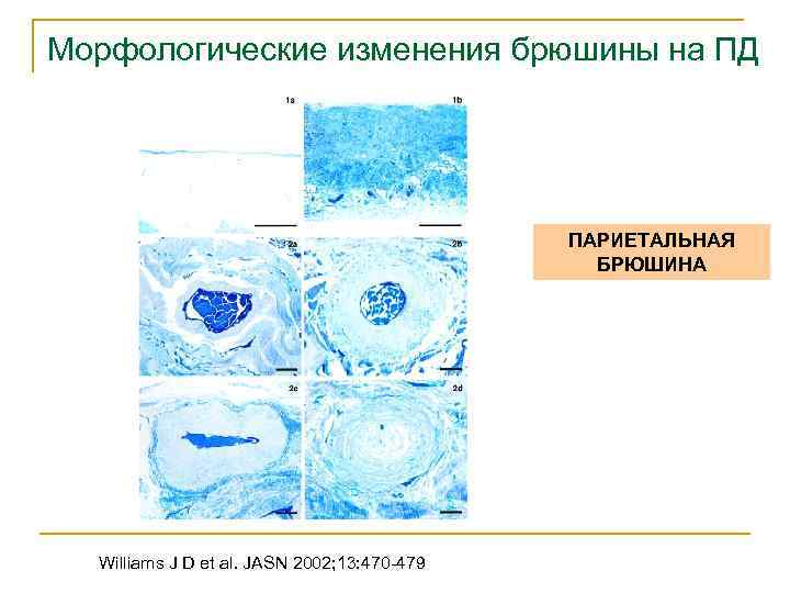 Морфологические изменения брюшины на ПД ПАРИЕТАЛЬНАЯ БРЮШИНА Williams J D et al. JASN 2002;