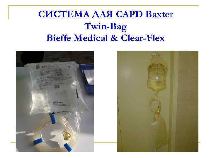 СИСТЕМА ДЛЯ CAPD Ваxter Twin-Bag Bieffe Medical & Clear-Flex 