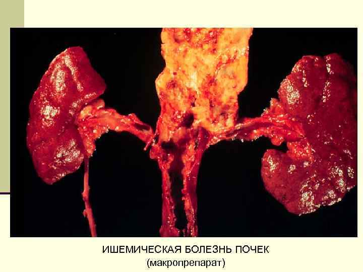 ИШЕМИЧЕСКАЯ БОЛЕЗНЬ ПОЧЕК (макропрепарат) 