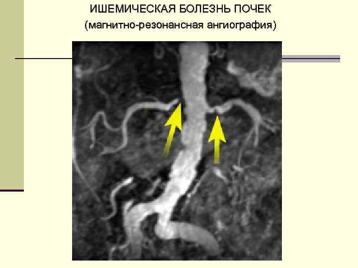 ИШЕМИЧЕСКАЯ БОЛЕЗНЬ ПОЧЕК (магнитно-резонансная ангиография) 