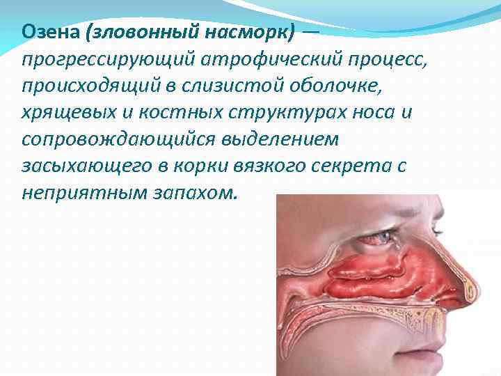 Озена (зловонный насморк) — прогрессирующий атрофический процесс, происходящий в слизистой оболочке, хрящевых и костных