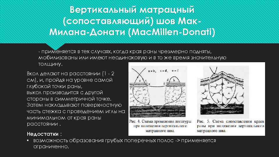 Вертикальный матрацный (сопоставляющий) шов Мак. Милана-Донати (Mac. Millen-Donati) - применяется в тех случаях, когда
