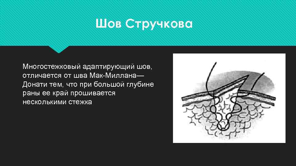 Шов Стручкова Многостежковый адаптирующий шов, отличается от шва Мак-Миллана— Донати тем, что при большой