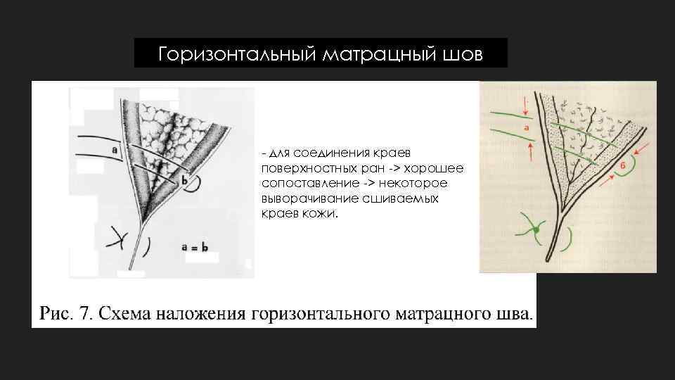 Горизонтальный матрацный шов - для соединения краев поверхностных ран -> хорошее сопоставление -> некоторое