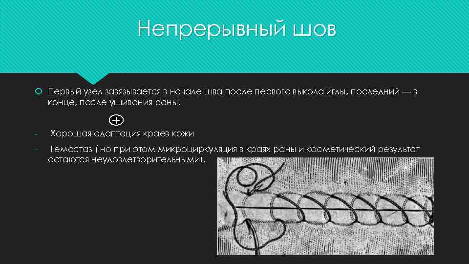 Непрерывный шов Первый узел завязывается в начале шва после первого выкола иглы, последний —