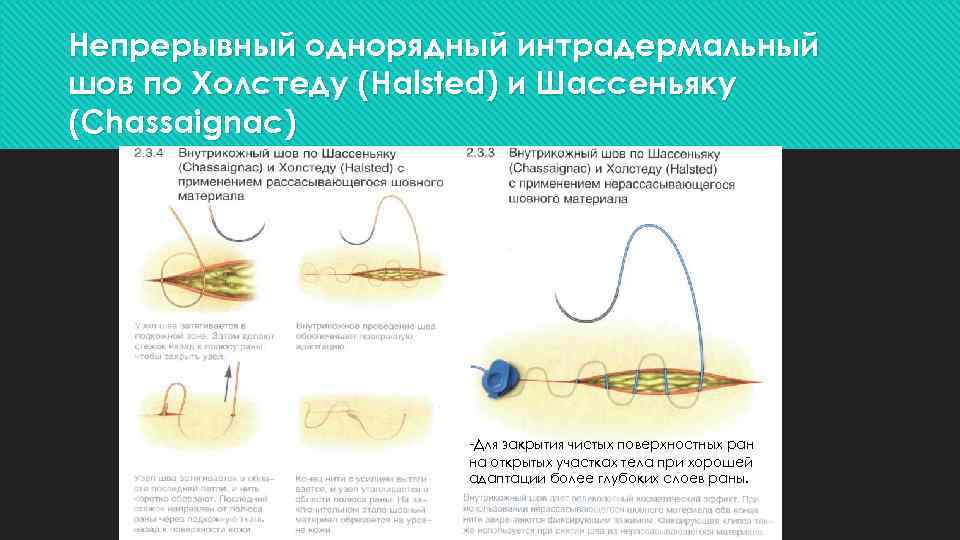 Непрерывный однорядный интрадермальный шов по Холстеду (Halsted) и Шассеньяку (Chassaignac) -Для закрытия чистых поверхностных