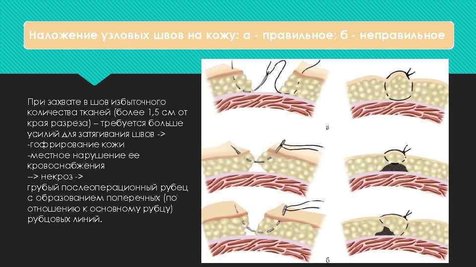 Наложение узловых швов на кожу: а - правильное; б - неправильное При захвате в
