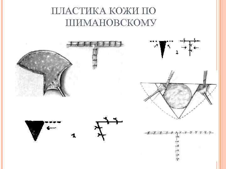 ПЛАСТИКА КОЖИ ПО ШИМАНОВСКОМУ 