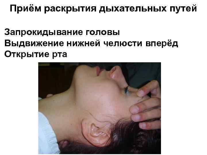 Приём раскрытия дыхательных путей Запрокидывание головы Выдвижение нижней челюсти вперёд Открытие рта 