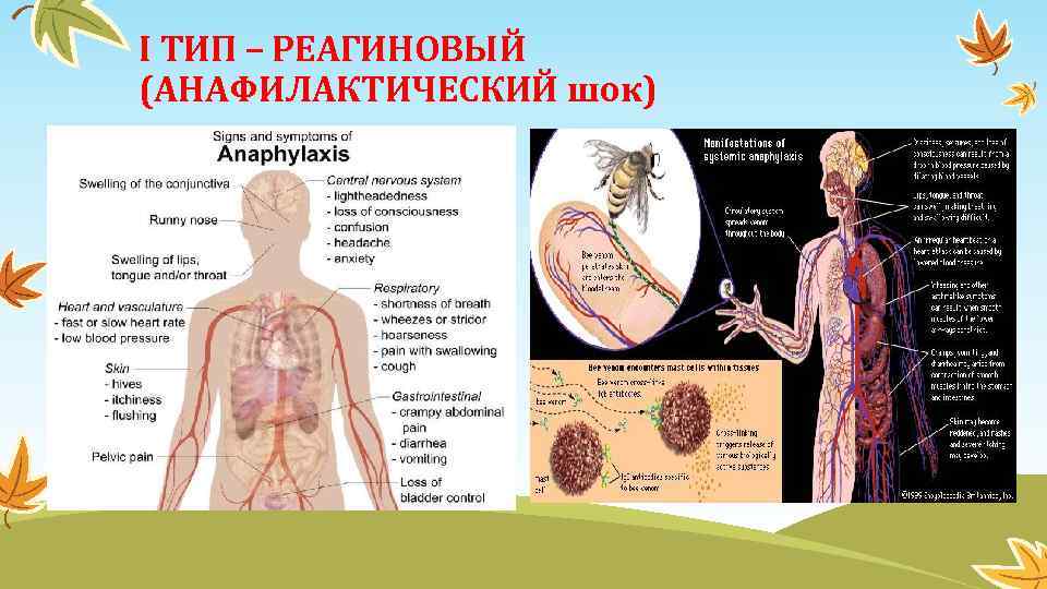 I ТИП – РЕАГИНОВЫЙ (АНАФИЛАКТИЧЕСКИЙ шок) 