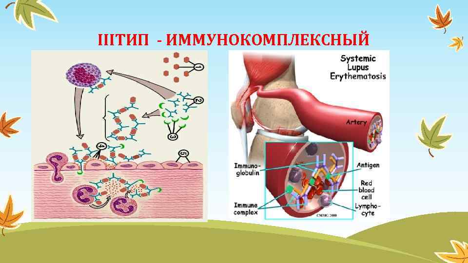 IIIТИП - ИММУНОКОМПЛЕКСНЫЙ 