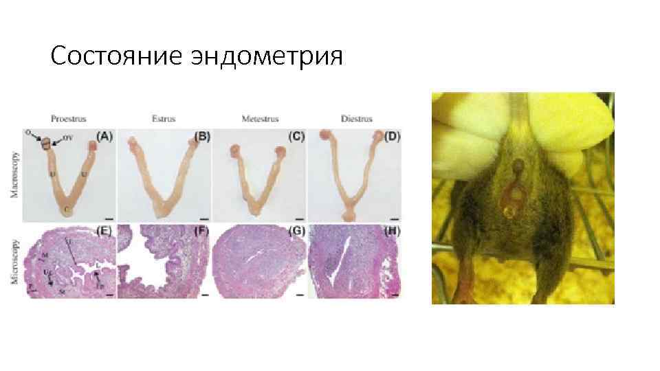 Состояние эндометрия 