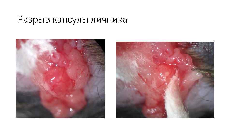 Разрыв капсулы яичника 