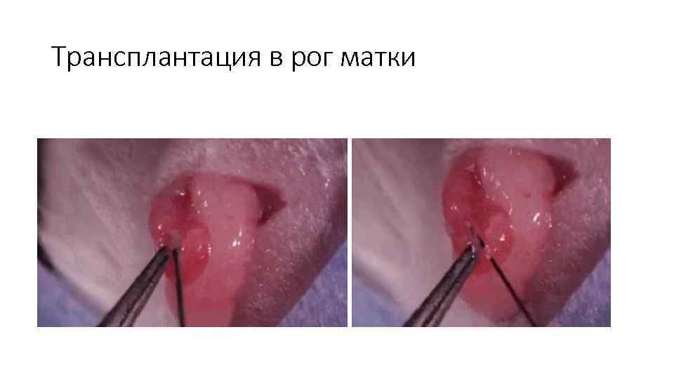 Трансплантация в рог матки 