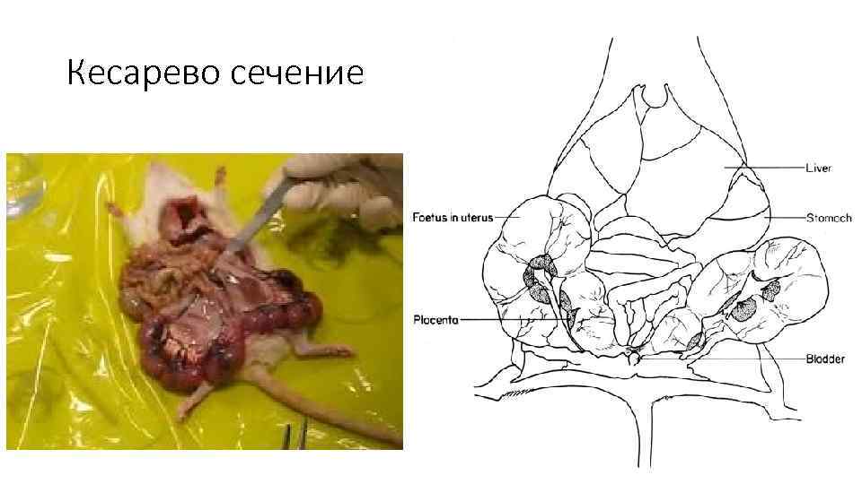 Кесарево сечение 