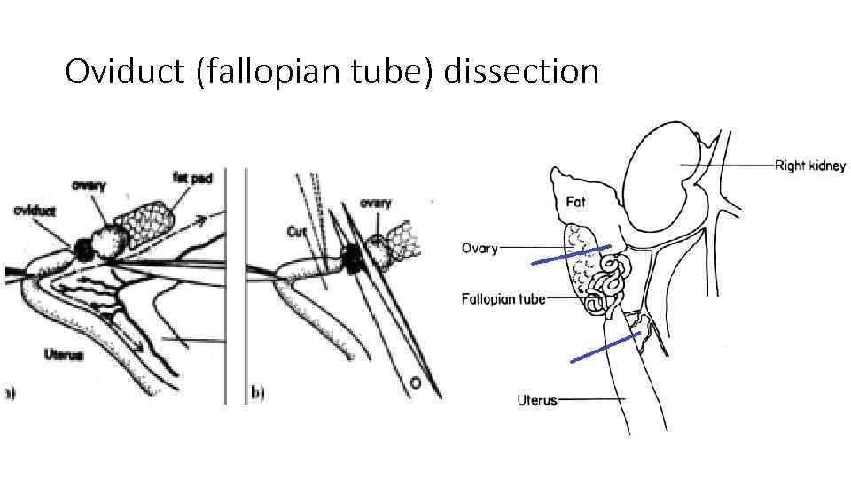 Oviduct (fallopian tube) dissection 