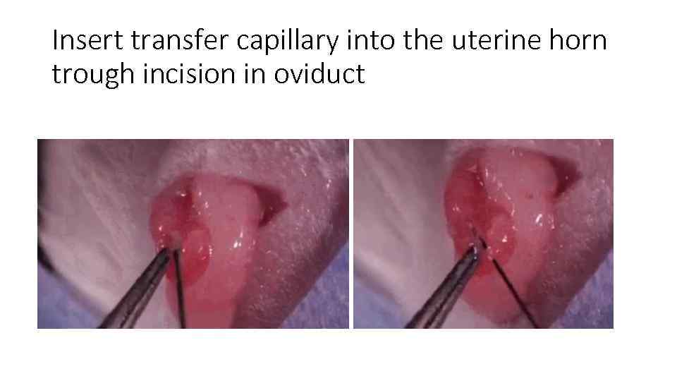 Insert transfer capillary into the uterine horn trough incision in oviduct 