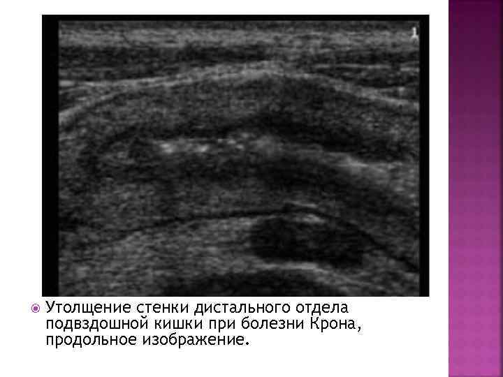  Утолщение стенки дистального отдела подвздошной кишки при болезни Крона, продольное изображение. 