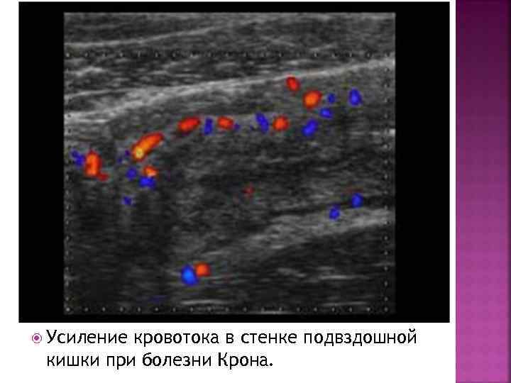  Усиление кровотока в стенке подвздошной кишки при болезни Крона. 