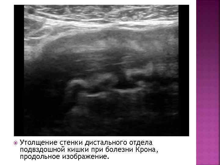  Утолщение стенки дистального отдела подвздошной кишки при болезни Крона, продольное изображение. 