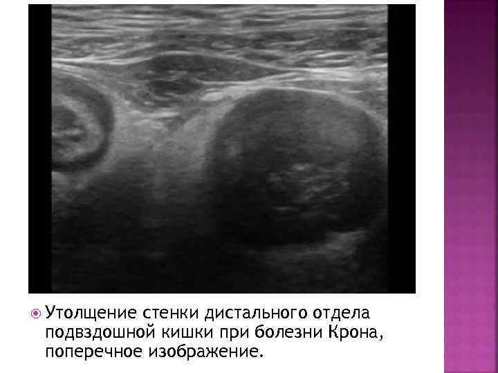  Утолщение стенки дистального отдела подвздошной кишки при болезни Крона, поперечное изображение. 